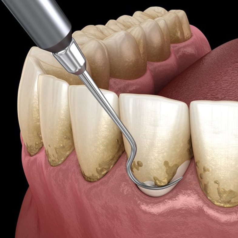 teeth-cleaning - Perfect 32 Dental Care